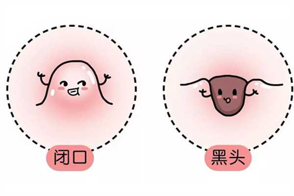 闭口长啥样?闭口怎么除 闭口长啥样?闭口怎么除