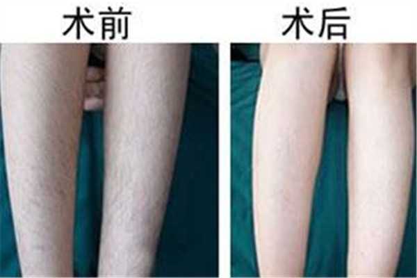 汗毛多怎么去除