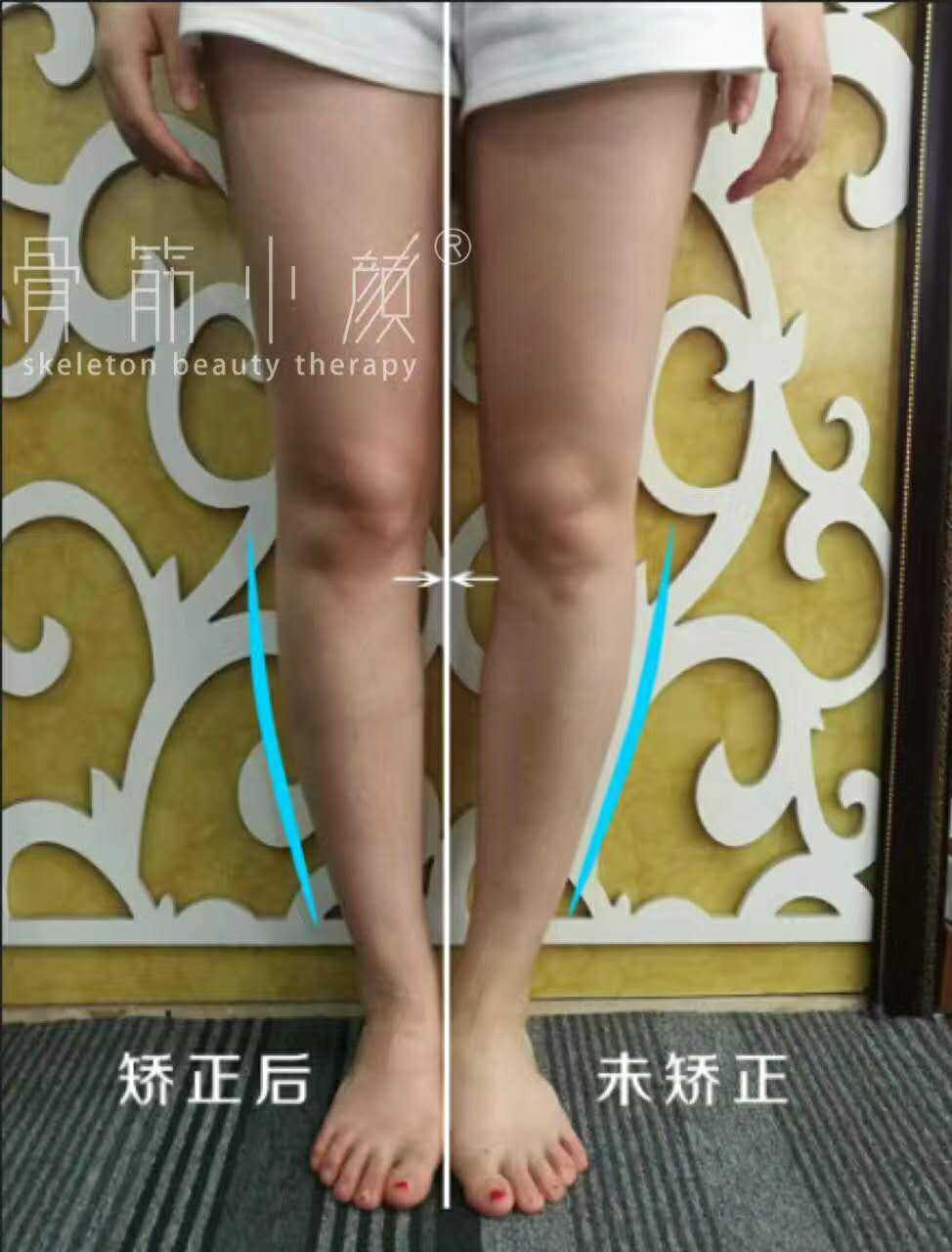 日式整骨有效果吗?效果对比图 日式整骨有效果吗?效果对比图