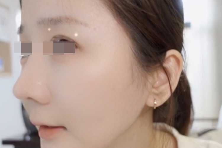 面部微雕一次一般多少钱？面部线雕一到7天图片