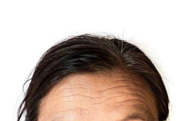 抬头纹是天生的还是后天的？抬头纹是遗传的吗