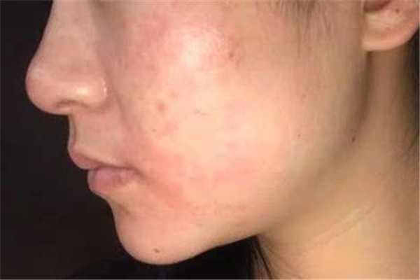 敏感肌脸部发红怎么修复 敏感肌怎么修复成正常肌肤