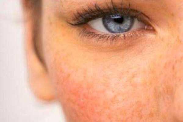 晒斑怎么去除掉？晒斑能彻底根除吗