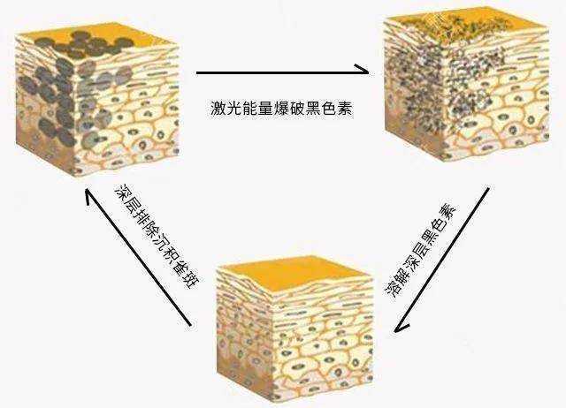 为什么说皮秒是祛斑最有效的方法？