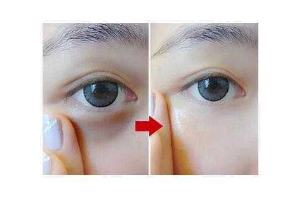 黑眼圈能自己消除吗 黑眼圈手术一般多少钱