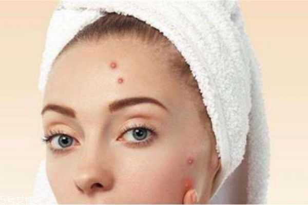 下巴两侧上长痘痘是什么原因