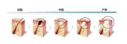 红肿痘痘怎么快速消肿