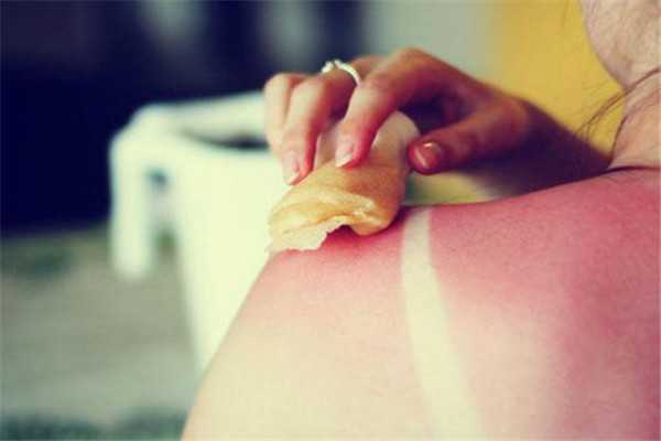 晒伤是什么感觉