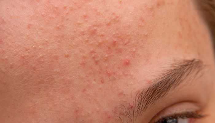 积雪苷霜软膏可以去痘印吗 积雪苷霜软膏可以去痘印吗