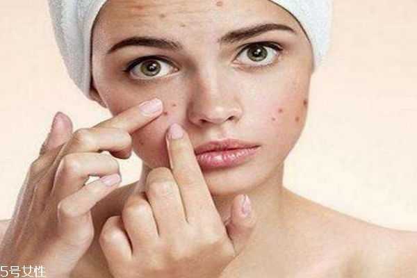 痘痘肌应该用什么面膜呢 痘痘肌应该用什么面膜呢