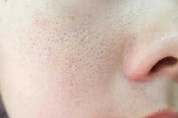 毛孔粗大怎么办怎么收缩毛孔 毛孔粗大用什么护肤品可以改善