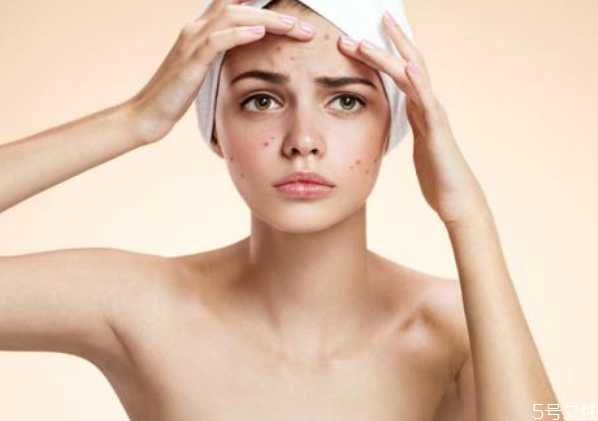 戴口罩下巴长痘痘怎么办？怎样避免戴口罩闷痘