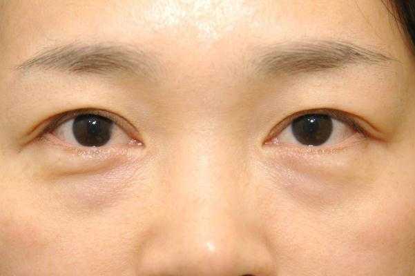 眼袋为什么是青黑色 眼袋为什么早上冰敷晚上热敷