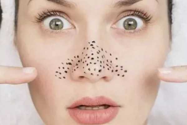 黑头是怎么形成的？