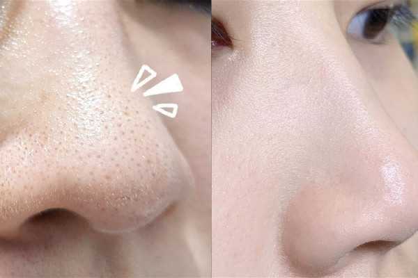 黑头粉刺怎么才能彻底根除 黑头粉刺怎么才能彻底根除