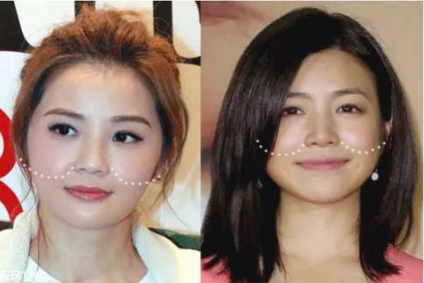 法令纹明显怎么办 法令纹的形成原因