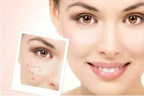 痤疮如何治疗效果好