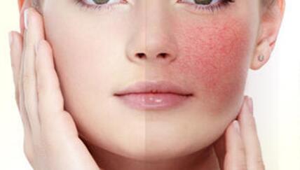 脸刺痛泛红怎么办？盘点脸上刺痛原因