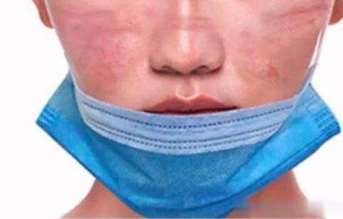 每天戴口罩过敏怎么办？