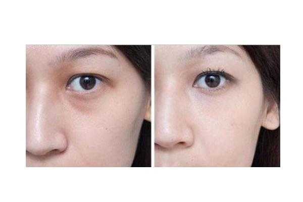 眼袋可以针灸治疗吗 眼袋可以按摩去除吗