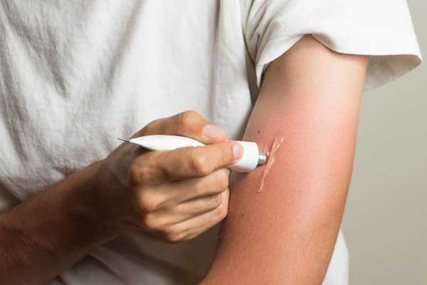 晒伤后怎么变白