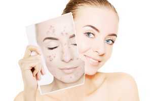 原来这才是毛孔粗大的原因 原来这才是毛孔粗大的原因