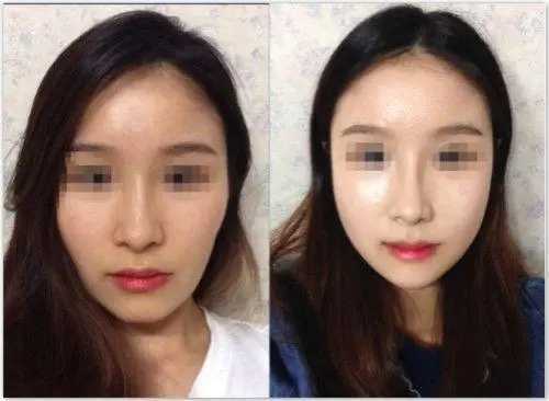 小颜整骨真的有用吗?小颜整骨效果好吗 小颜整骨真的有用吗?小颜整骨效果好吗