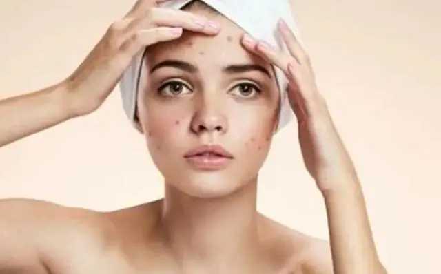 有效祛痘印的方法都有哪些 有效祛痘印的方法都有哪些