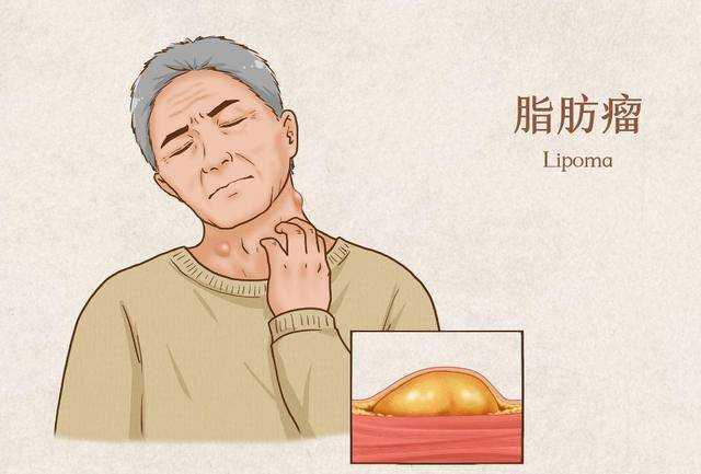 皮肤上的“小肉疙瘩”究竟是什么呢？