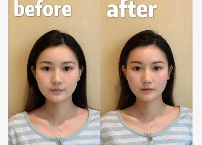 日本颧骨整形费用多少