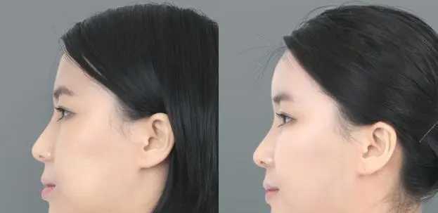 脸部整骨可以维持多久 脸部整骨可以维持多久