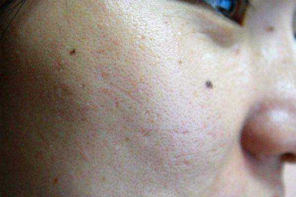 皮肤上的痣变得又大又黑，是怎么回事