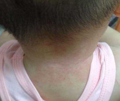 夏天宝宝长痱子怎么办 夏天宝宝长痱子怎么办