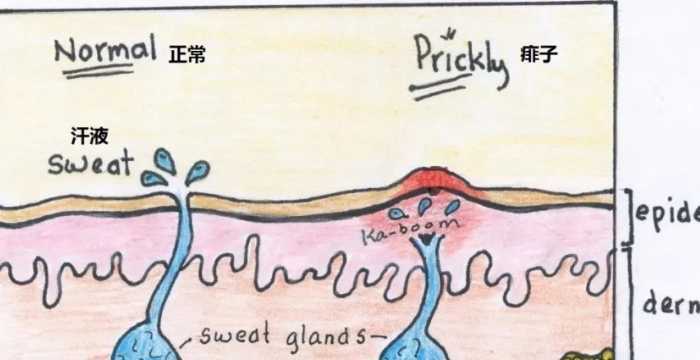 夏天宝宝长痱子怎么办 夏天宝宝长痱子怎么办