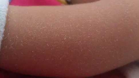 皮肤洗完澡后像脱皮一样 皮肤洗完澡后像脱皮一样