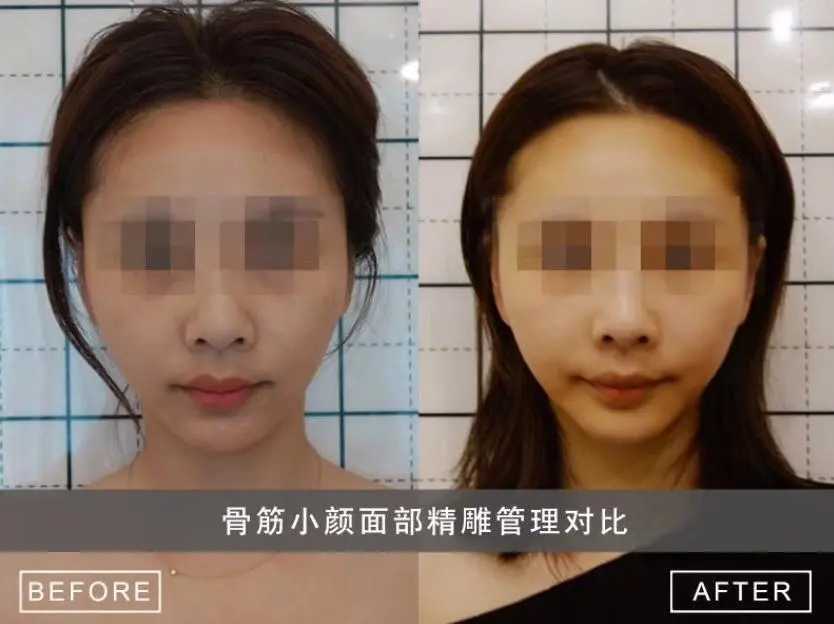 骨筋小颜与徒手整形的区别