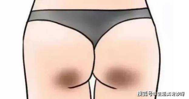 女生的屁股上为什么会有两坨“黑印”? 女生的屁股上为什么会有两坨“黑印”?