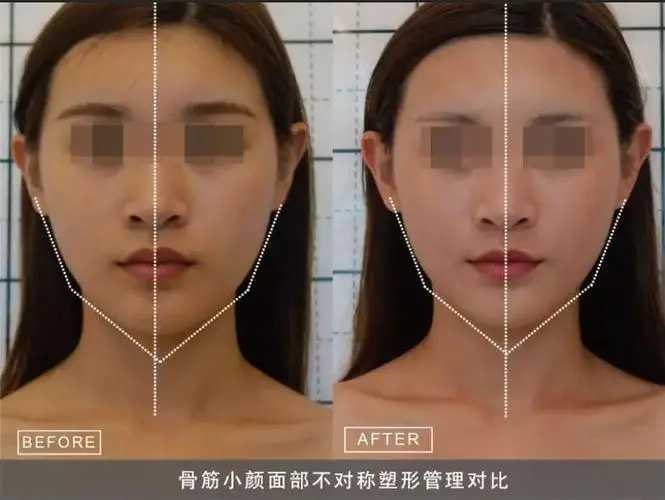 日式整骨小颜术真的可以改变脸型吗 日式整骨小颜术真的可以改变脸型吗