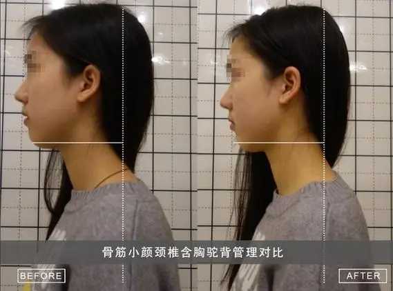 驼背日式整骨几次可以矫正 驼背日式整骨几次可以矫正