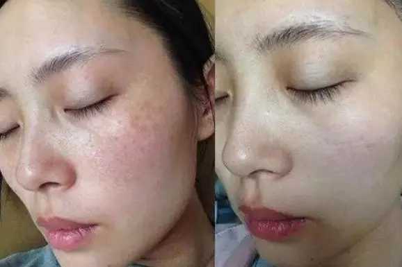 祛斑的最好的5种药膏 祛斑的最好的5种药膏