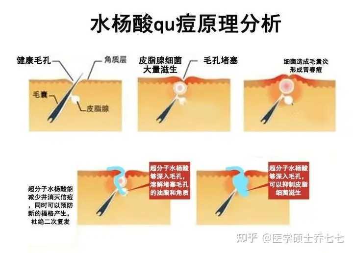 新手自己刷酸的正确方法步骤