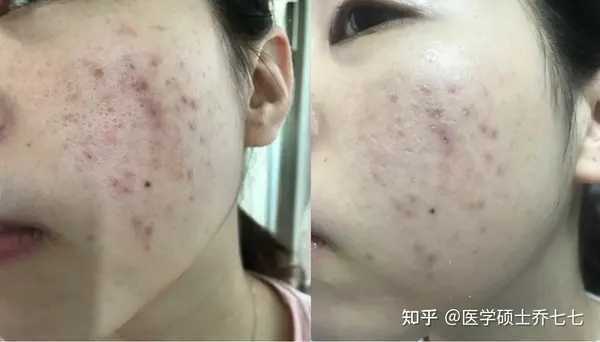 新手自己刷酸的正确方法步骤