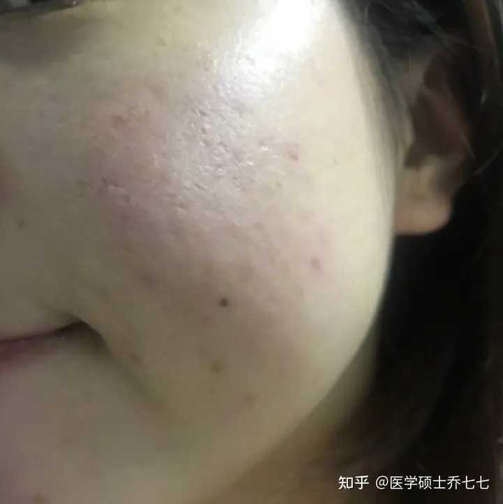 新手自己刷酸的正确方法步骤