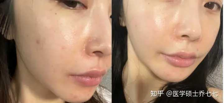 新手自己刷酸的正确方法步骤