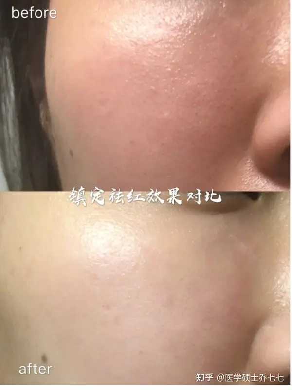 新手自己刷酸的正确方法步骤