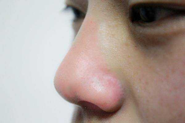 鼻子上一挤就出来的白色分泌物是什么? 鼻子上一挤就出来的白色分泌物是什么?