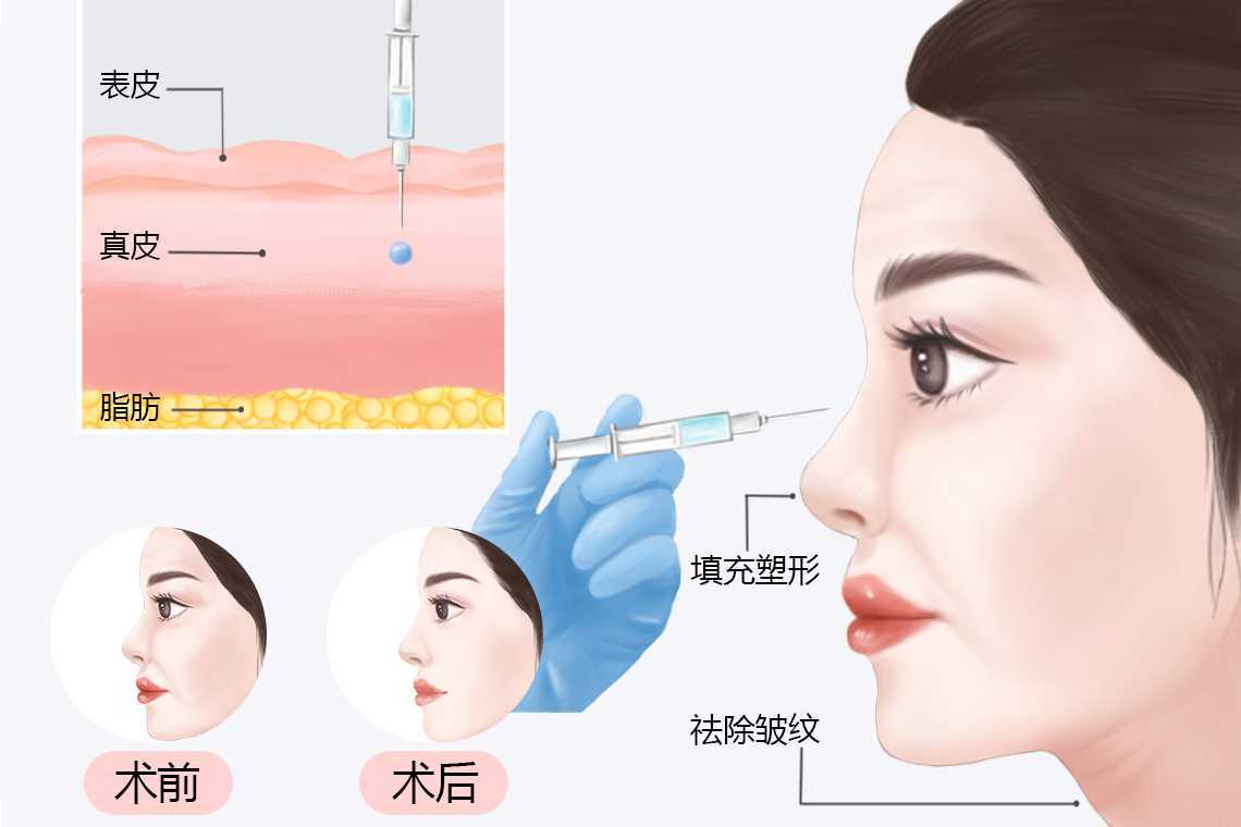 脸上抹玻尿酸怎么使用