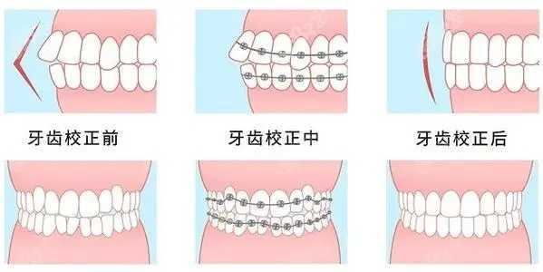 牙齿矫正大概要花费多少钱？5000~15000元不等