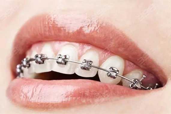 牙齿矫正大概要花费多少钱?看完这篇文章你就知道怎么选择了 牙齿矫正大概要花费多少钱?看完这篇文章你就知道怎么选择了