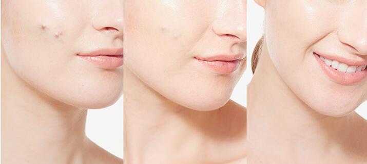 黑色痘印会自己消失吗? 黑色痘印会自己消失吗?